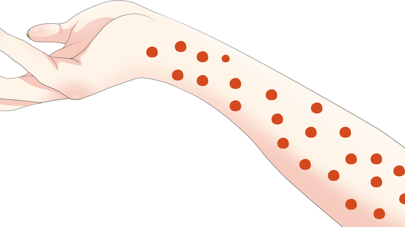 Niigata records its first measles case since 2019 photo