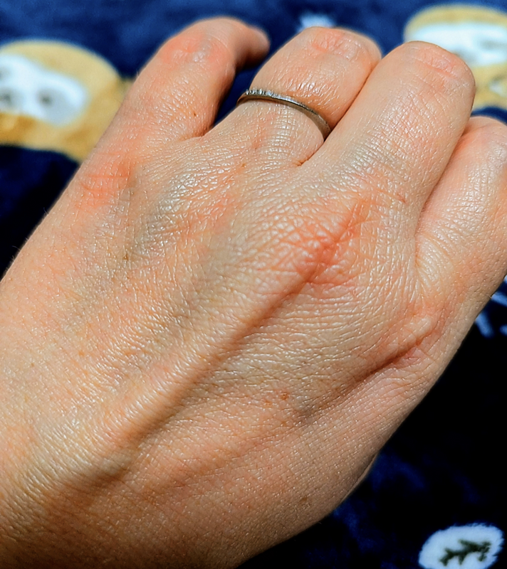 Lotion for Dry, Bleeding Hands photo