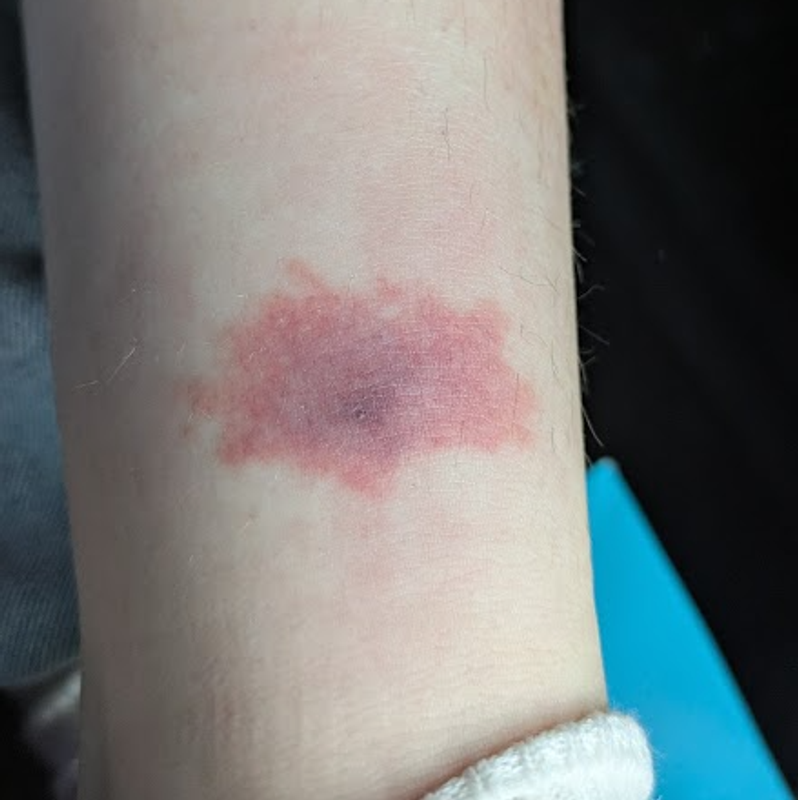 My first experience with a black fly bite (photo contained in post) photo